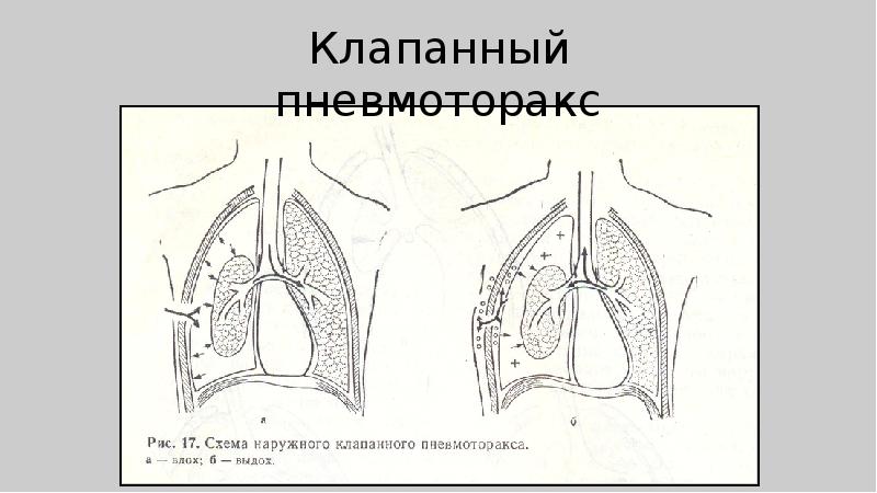 Торакальная хирургия презентация