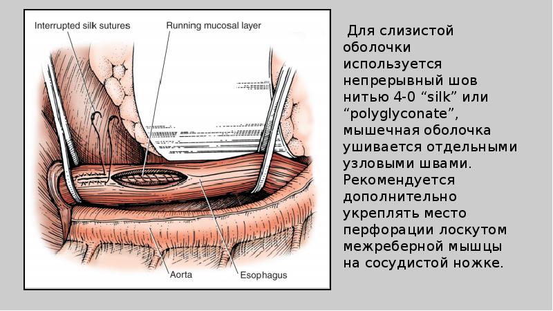 Торакальная хирургия презентация