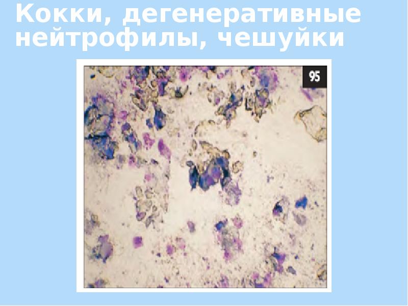Плоскоклеточная карцинома цитология. Синапс микрофотография. Кариопикноз кариорексис кариолизис. Трихомонада микроскопия. Кариорексис буккальный эпителий.
