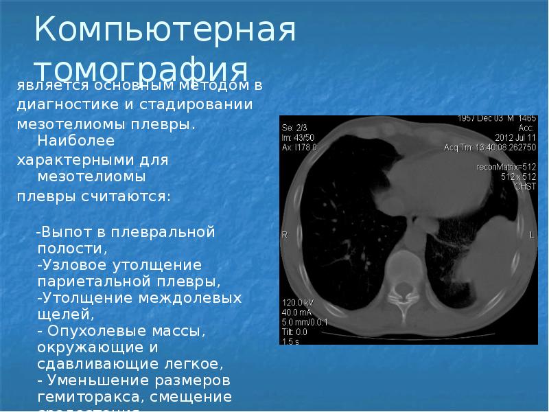 Мезотелиома плевры кт картина