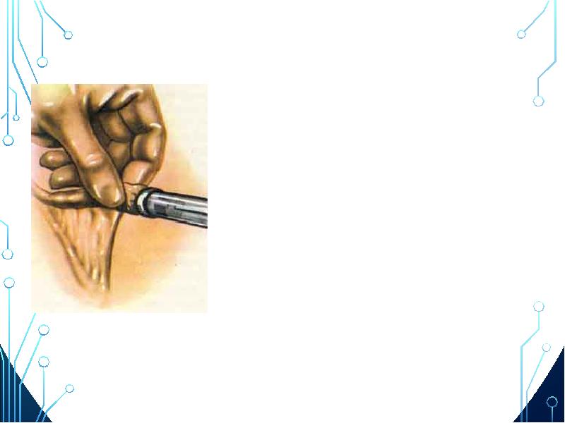 Сальпинголизис     Жатыр түтігін қысатын және оны жабатын