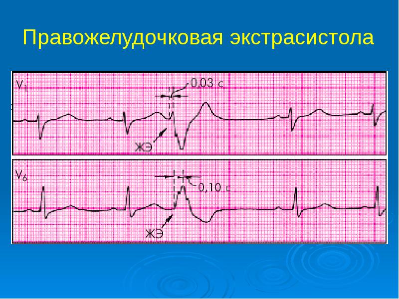 Правожелудочковые экстрасистолы. Правожелудочковая экстрасистолия. Правожелудочковые экстрасистолы на ЭКГ. Экстрасистолы типа r на t.