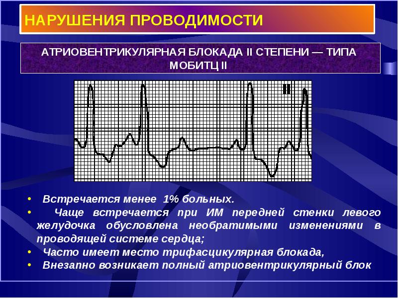 Нарушения проводимости презентация