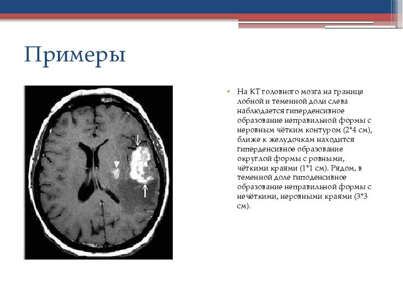 Постишемические изменения мозга. Опухоль лобной доли головного кт. Кисты в теменных долях на кт. Гиподенсные очаги головного мозга на кт. Доли головного мозга на кт анатомия.