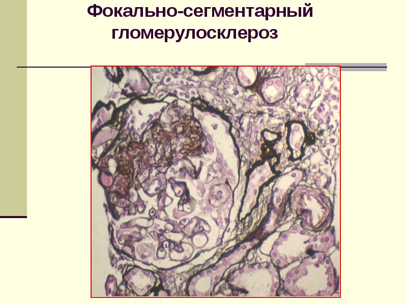 Хронический гломерулонефрит презентация