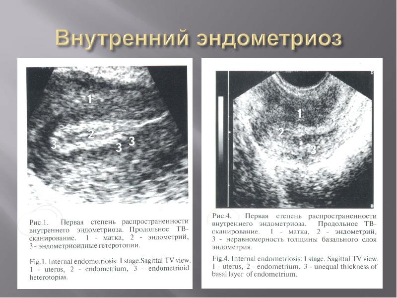 Узи признаки эндометриоза матки. Эндометриоз эндометрия УЗИ. Эндометриоз 1 степени на УЗИ.