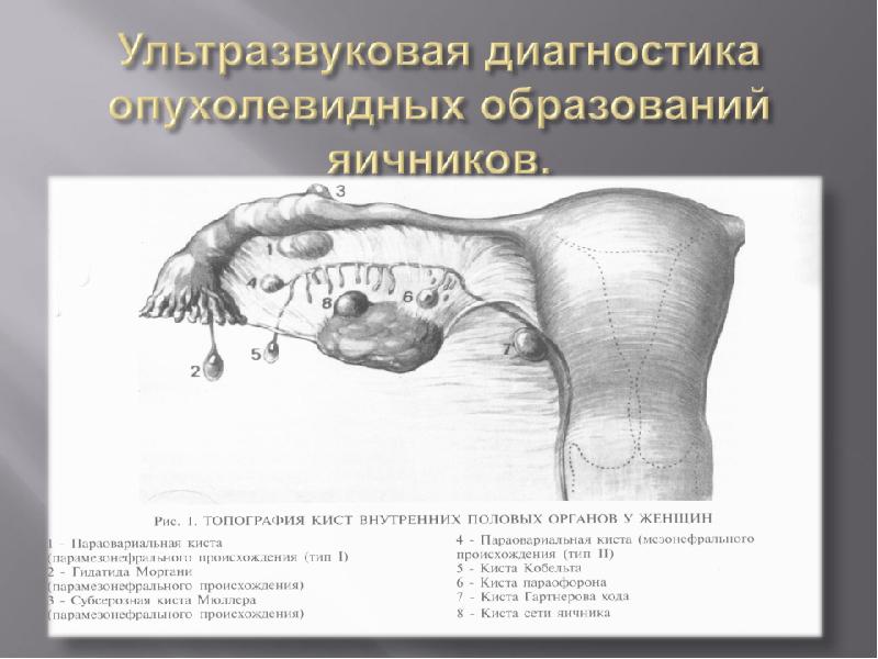 Параовариальная киста яичника. Киста гартнерова протока. Кисты Мюллера и гартнерова хода..