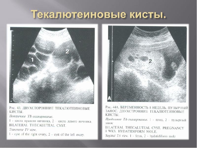 Пузырный занос картинки узи