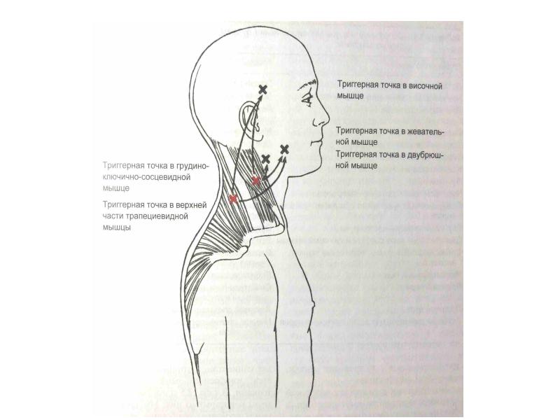 Триггерные точки шея голова