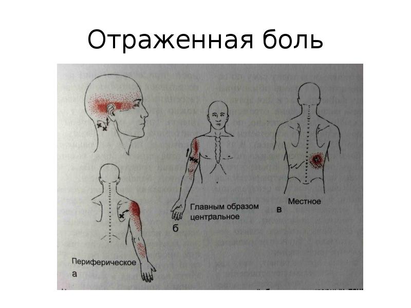 Карта отраженной боли