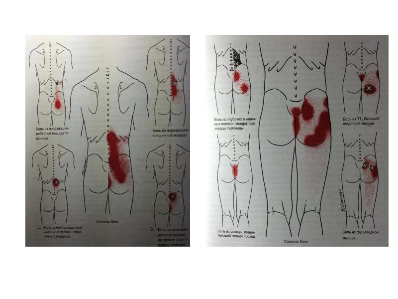 Триггерные точки карта отраженной боли