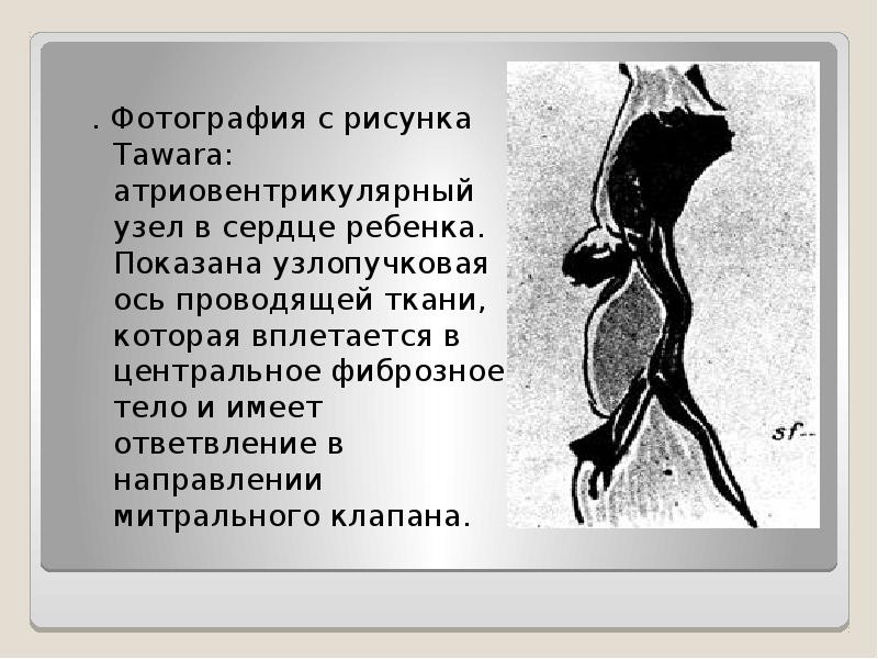 . Фотография с рисунка Tawara: атриовентрикулярный узел в сердце ребенка. Показана