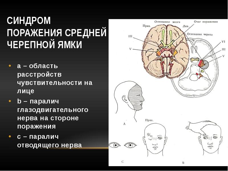 Паралич отводящего нерва. Синдромы поражения ствола. Синдромы поражения среднего мозга. Менингиома средней черепной ямки. Синдром поражения отводящего нерва.