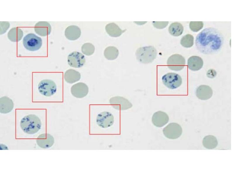 Ретикулоциты фото под микроскопом