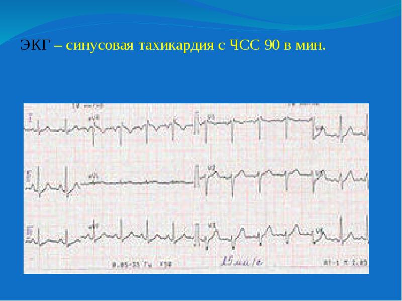 желудочковая тахикардия. тахикардия левого желудочка. пароксизмальная желудочковая тахикардия на экг. желудочковая тахикардия на экг признаки. желудочковая тахикардия сердце.