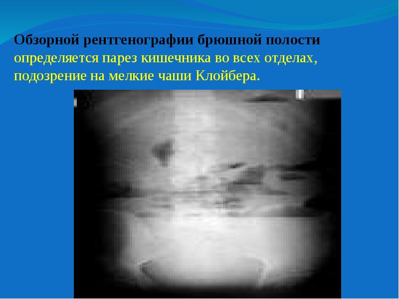 Парез кишечника это. Обзорная рентгенография брюшной полости чаши Клойбера. Парез кишечника рентген. Обзорная рентгенограмма брюшной полости чаши Клойбера. Парез кишечника на рентгенограмме.