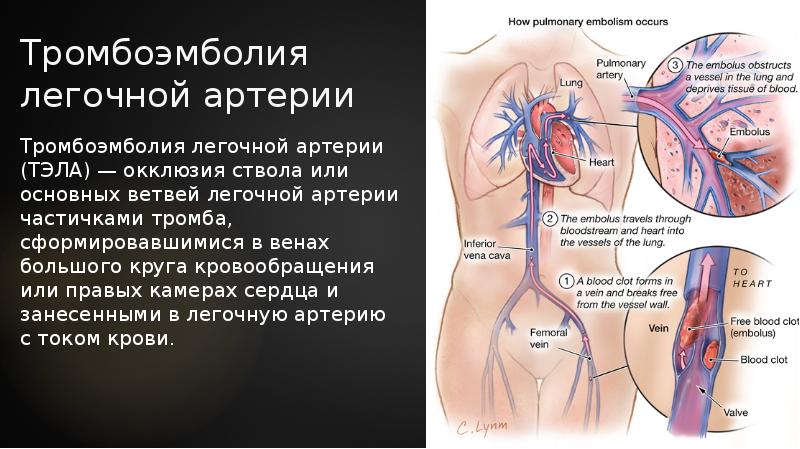 Тромбоэмболия легочной артерии презентация