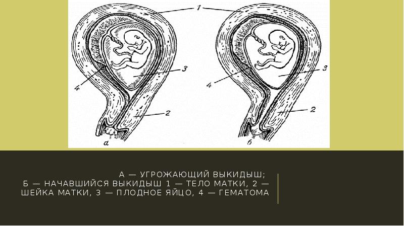 Что такое две матки у женщины. Что такое две матки у женщины