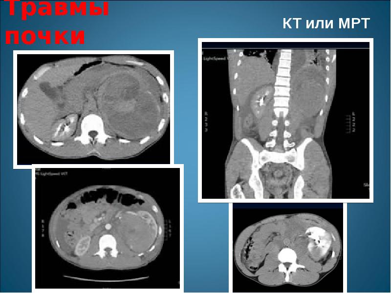 Травмы почек презентация