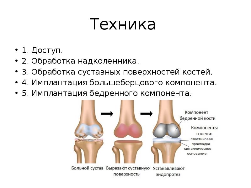 Эндопротезирование суставов презентация