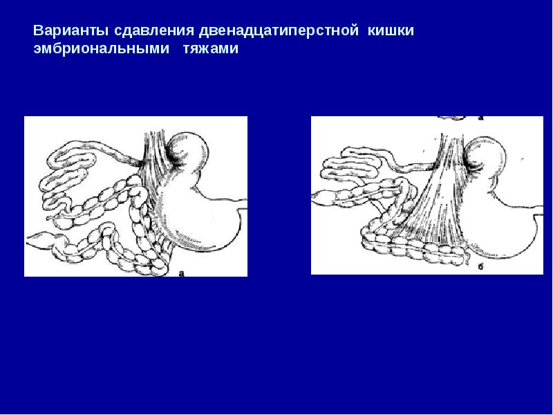 Атрезия прямой кишки операция. Сдавление двенадцатиперстной кишки. Эмбриональный тяж брюшины. Эмбриональные тяжи кишечника.