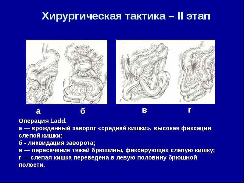 Врожденная кишечная непроходимость презентация