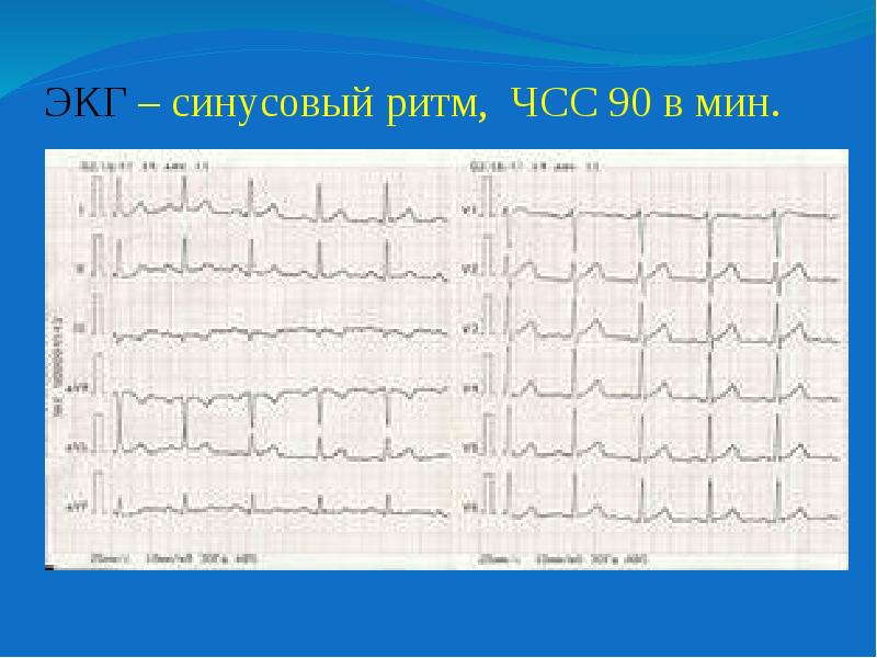 Ритмы чсс. Электрокардиограмма показатели синусовый ритм. ЭКГ ритм синусовый ЧСС 85 А мин. Кардиограмма сердца ритм синусовый ЧСС 62. ЭКГ ритм синусовый 85.