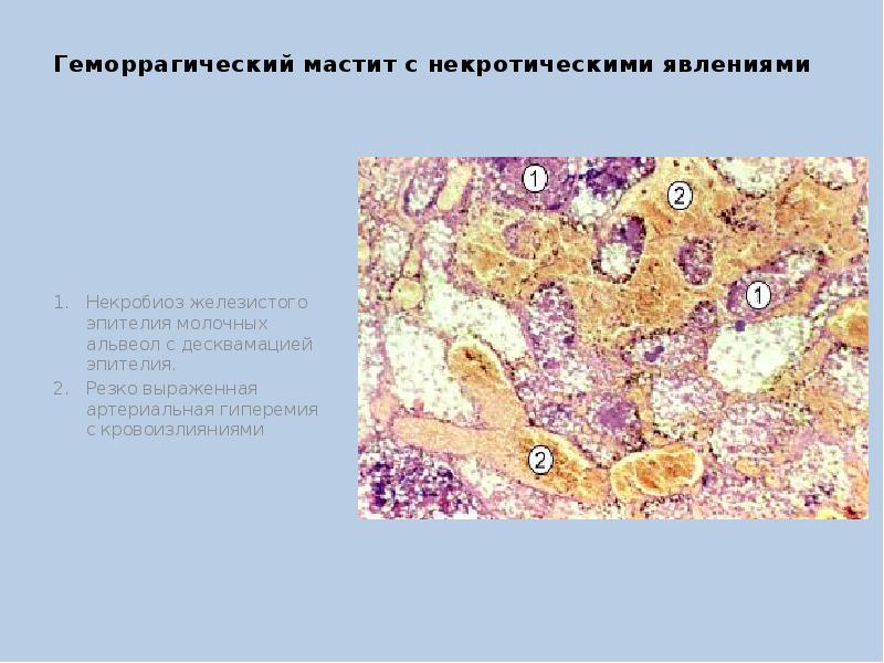 Мастит возбудители. Геморрагический мастит. Десквамация бронхиального эпителия.