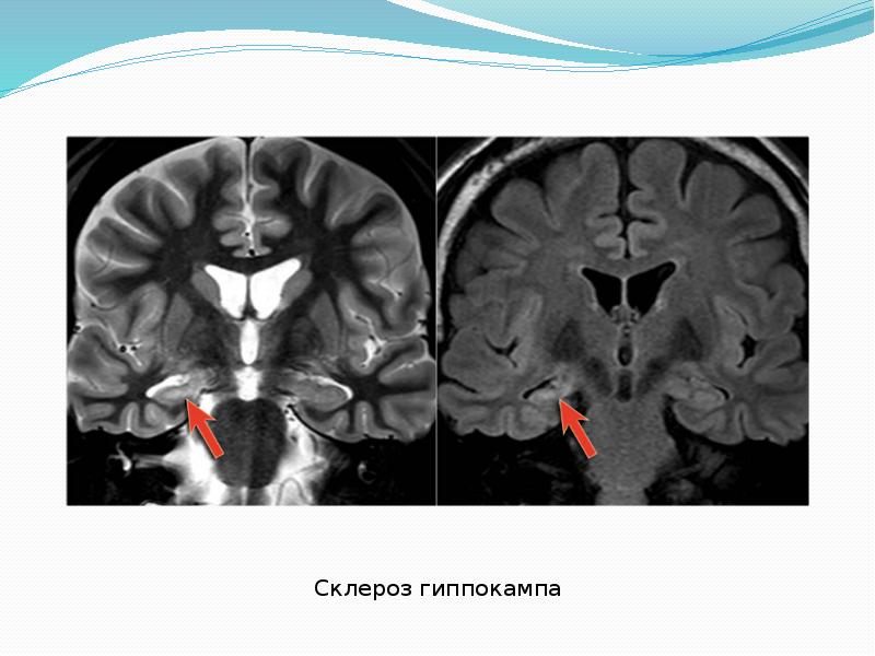 Гиппокамп на мрт картинки