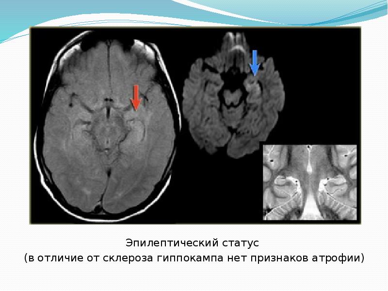 Гиппокамп на мрт картинки