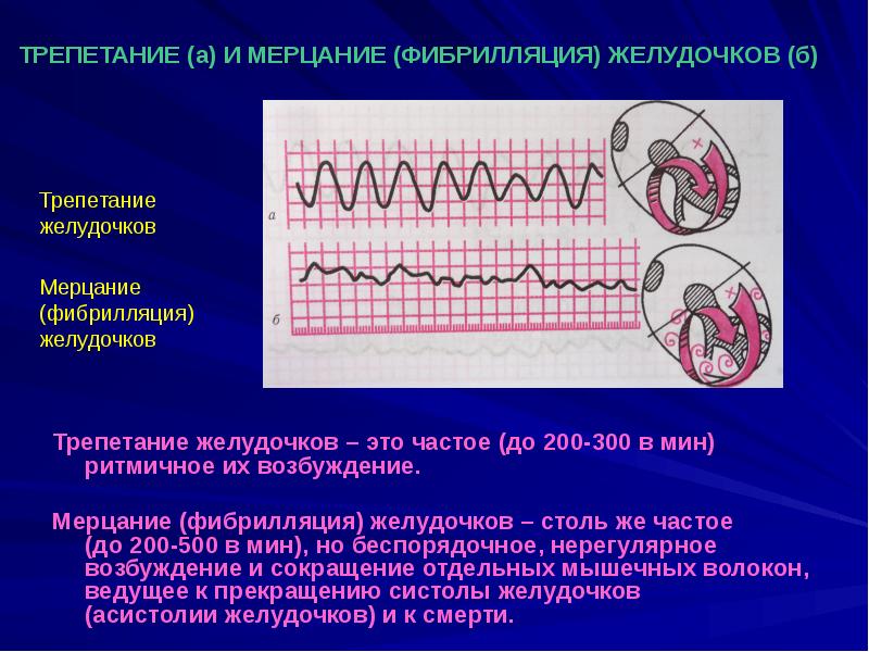 Мерцание на экг. Морфологические проявления фибрилляции желудочков сердца. Фибрилляция предсердий и желудочков. Трепетание и фибрилляция желудочков на ЭКГ. Фибрилляция желудочков патогенез.