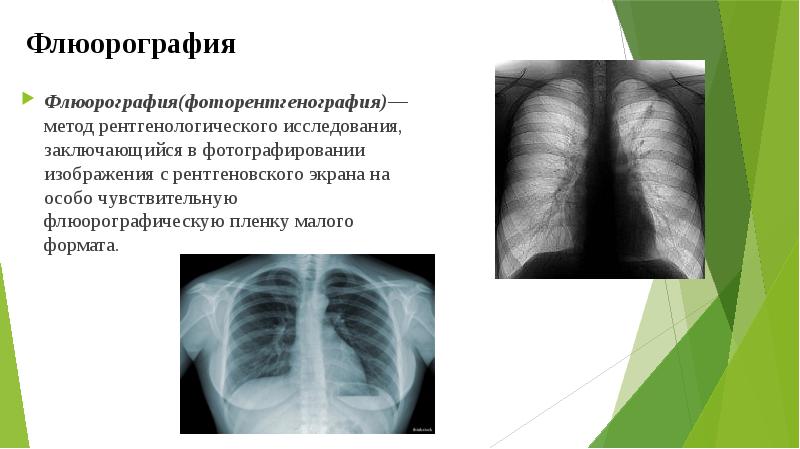 Это рентгенография с уменьшенным размером изображения получаемого на флюоресцирующем экране