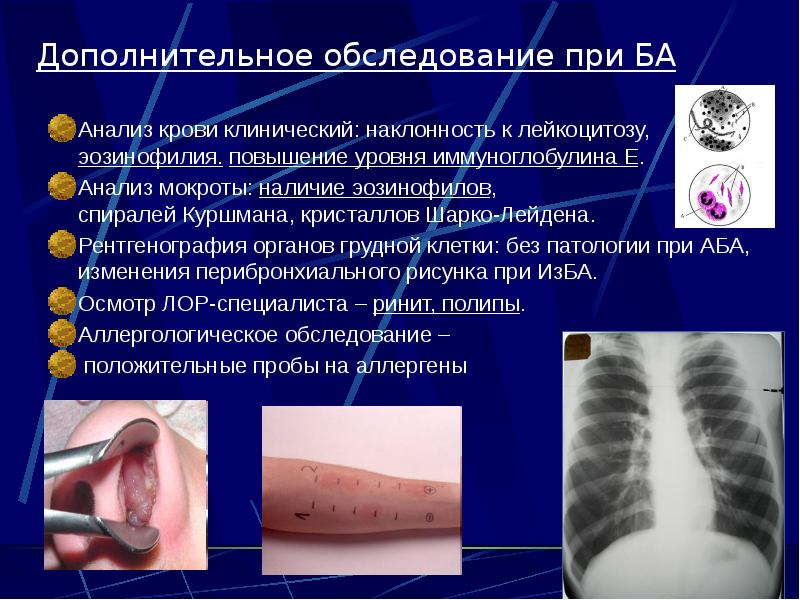 Дополнительное обследование при БА  Анализ крови клинический: наклонность к лейкоцитозу,
