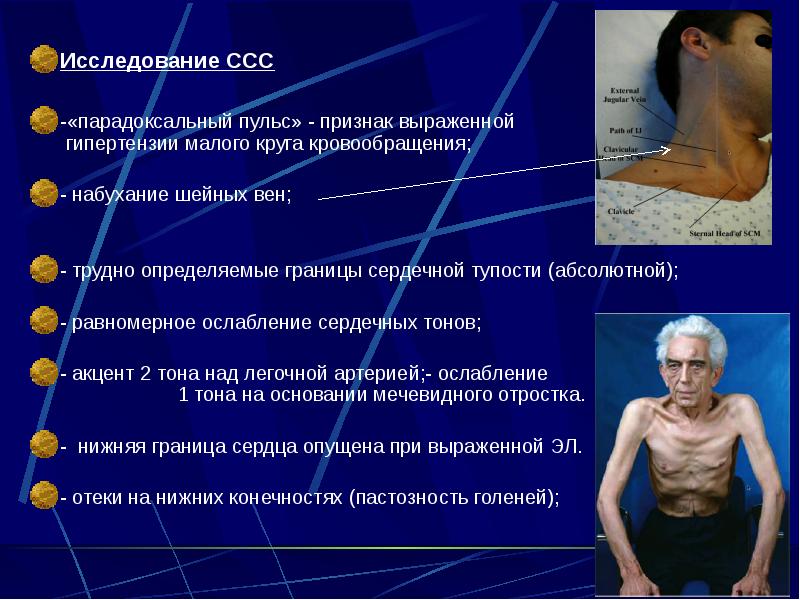 Исследование ССС Исследование ССС  -«парадоксальный пульс» - признак выраженной 