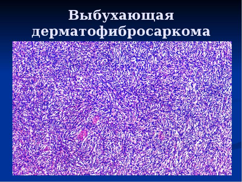 Мезенхимальные опухоли патанатомия презентация