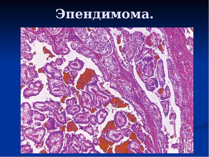 Мезенхимальные опухоли патанатомия презентация