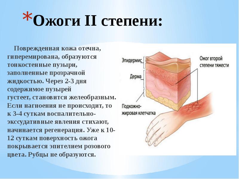 Степени ожогов кожи. Ожог ожог второй степени.