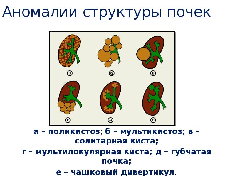 Дисплазия почки презентация