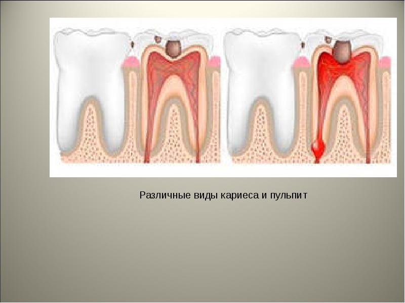 Кариес пульпит периодонтит презентация по стоматологии