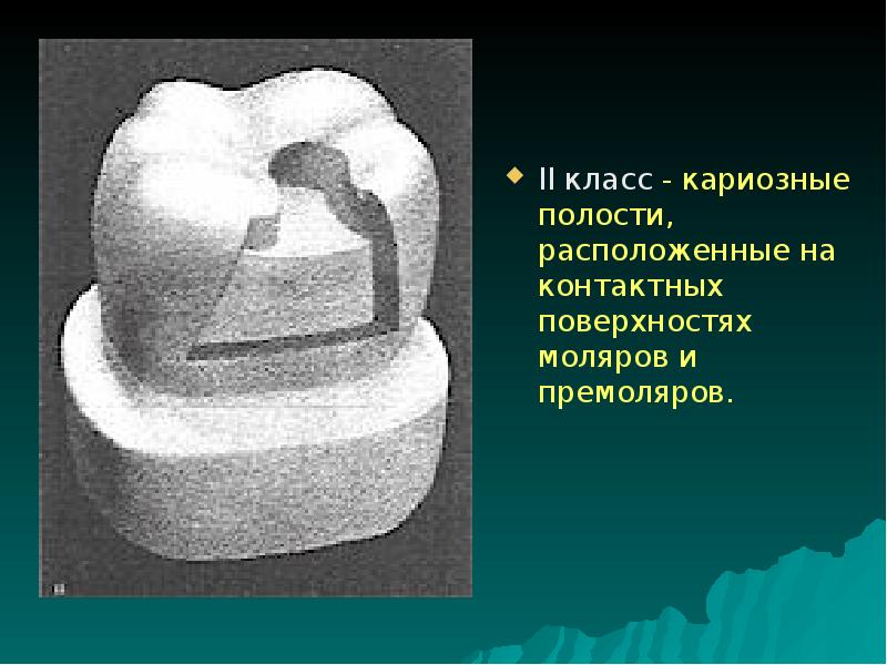 Классы по блэку в стоматологии в картинках