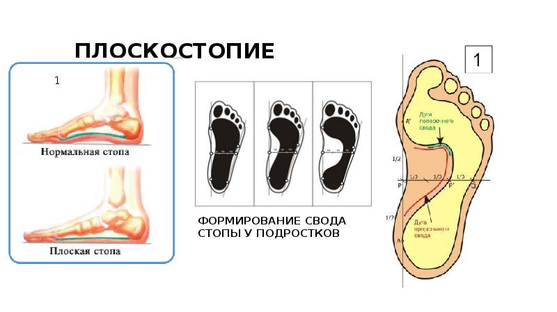 Плоскостопие 2 степени какая группа