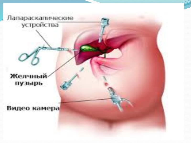 Жедел холецистит презентация