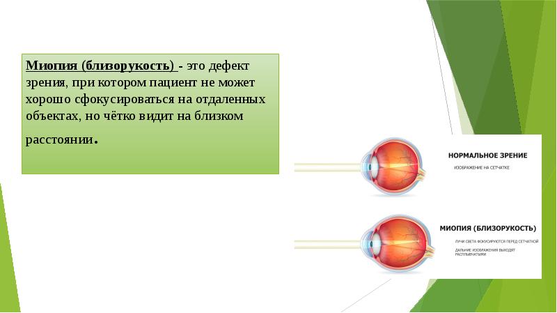 Реабилитация при миопии презентация