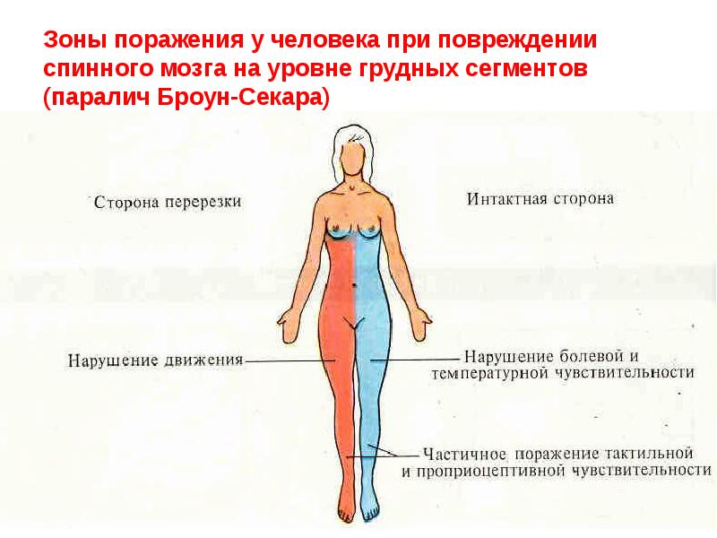 Зоны поражения у человека при повреждении спинного мозга на уровне грудных Зоны поражения у человека при повреждении спинного мозга на уровне грудных