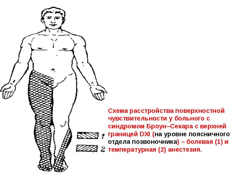 Схема расстройства поверхностной чувствительности у больного с синдромом Броун–Секара с верхней Схема расстройства поверхностной чувствительности у больного с синдромом Броун–Секара с верхней