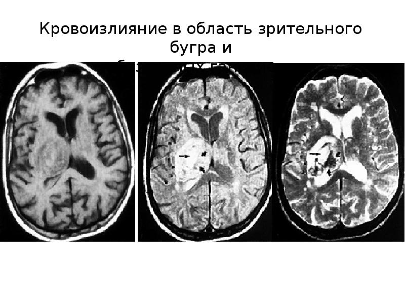 Кровоизлияния головного мозга последствия