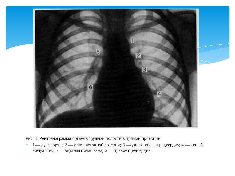 Прямая проекция рентгенограмма. Рентген обзорный грудная полость. Рентгенограмма в прямой проекции. Рентгенограмма органов грудной полости. Рентгенография органов грудной полости в прямой проекции.