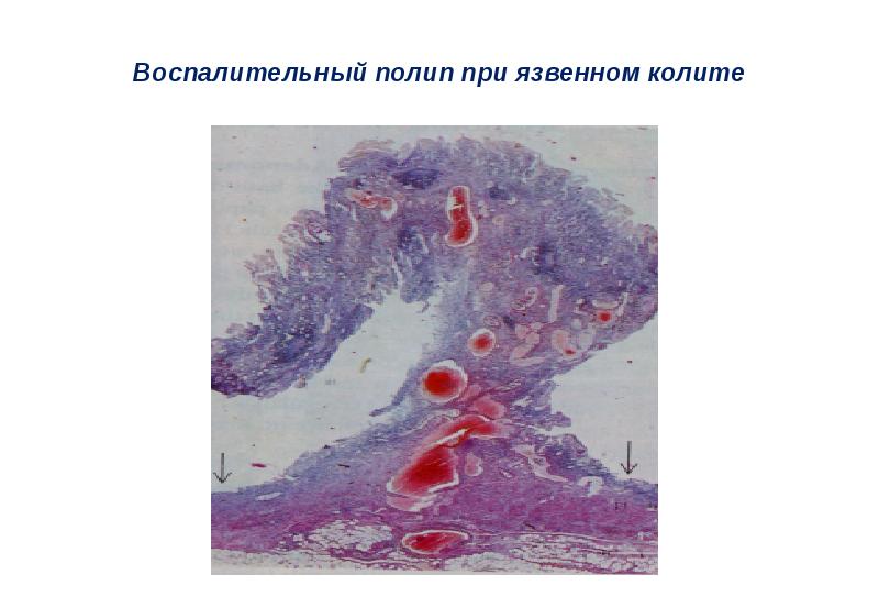 Ишемический колит презентация