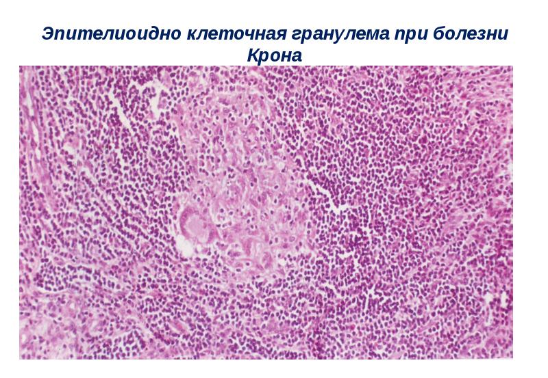 Болезнь крона гистологическая картина