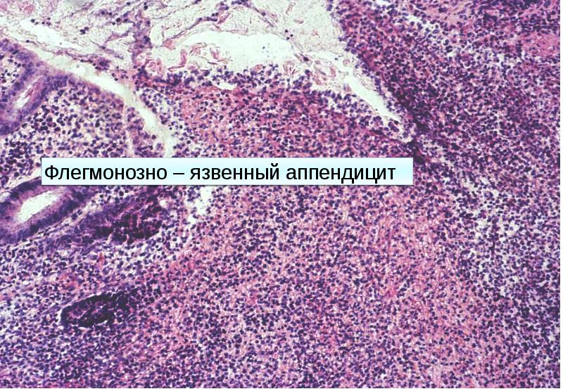 Флегмонозный аппендицит микропрепарат рисунок